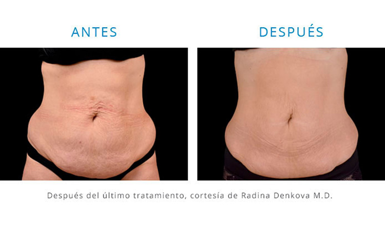 tratamiento de abdomen con emsculpt