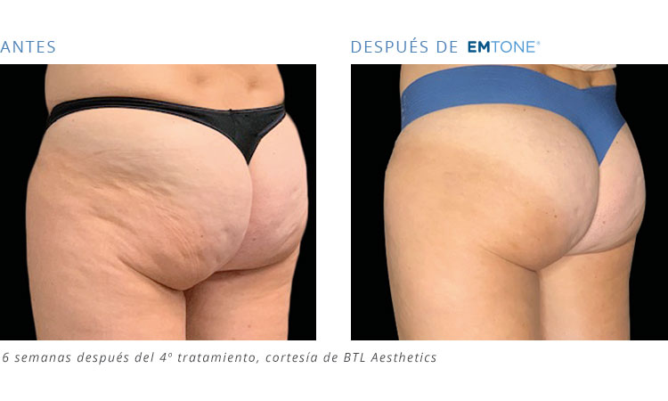 tratamiento de gluteos con emtone