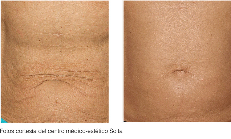 tratamiento corporal lifting de abdomen con thermage